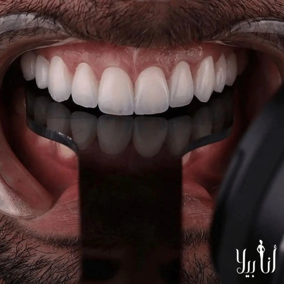 نتيجة تصميم الابتسامة